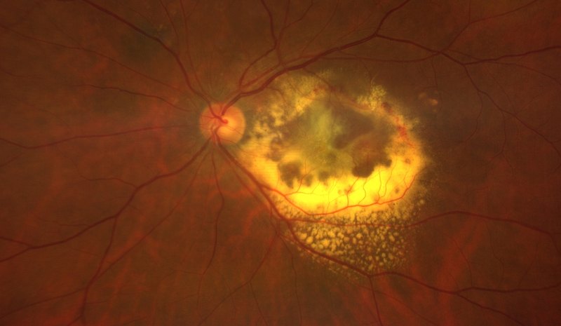 Fundus photograph of neovascular macular degeneration with a ring of hard exudate at the macula.