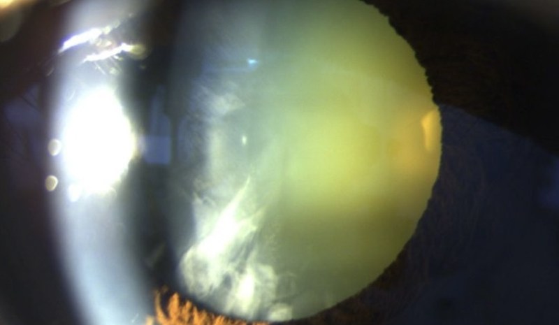 Slit lamp photograph of a dense cataract with the lens turned opaque yellow-white.