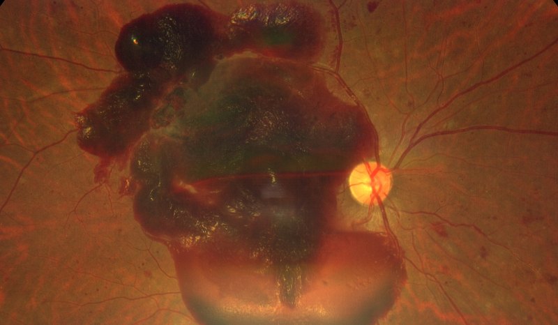 Fundus photograph of proliferative diabetic retinopathy with a large premacular haemorrhage.