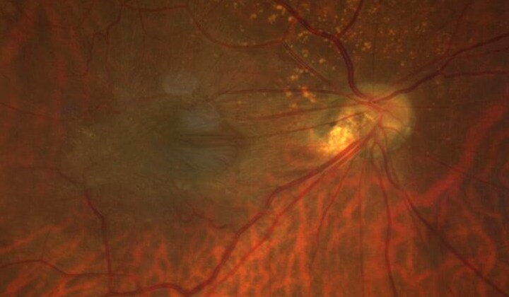Zoomed fundus photograph of an epiretinal membrane over the macula.
