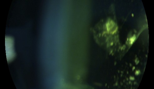 Slit lamp photograph of collagen clumps in the vitreous that cause floaters.