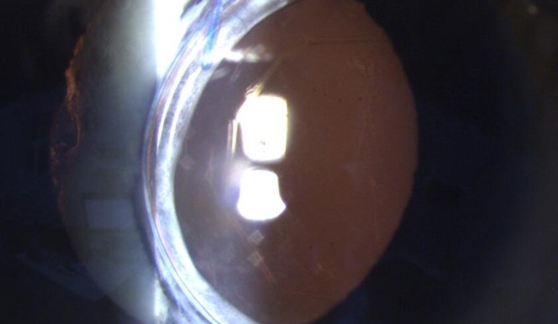 Slit lamp photograph of a subluxed intraocular lens with its edge crossing the pupil.