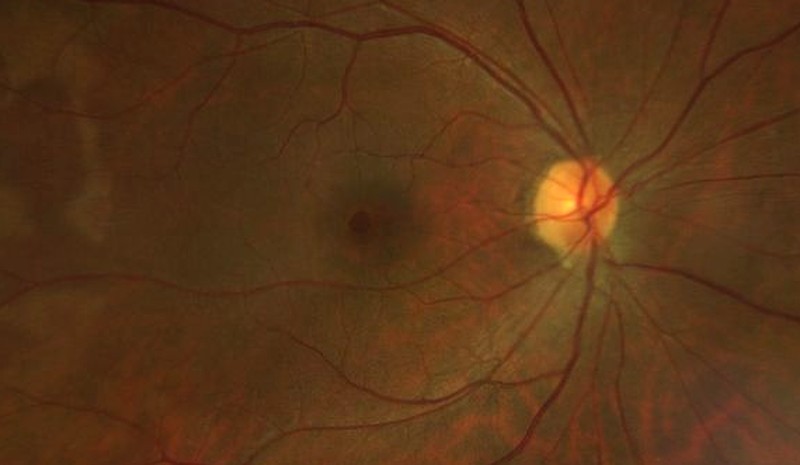 Fundus photograph of a full-thickness macular hole at the fovea.