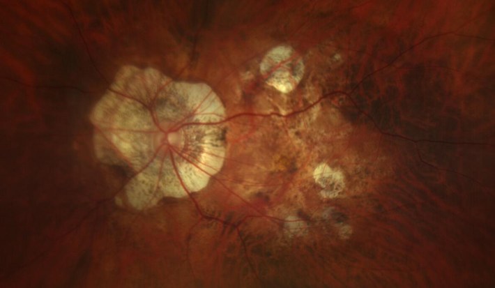 Fundus photograph of a highly myopic eye with peripapillary atrophy and patchy macular atrophy.