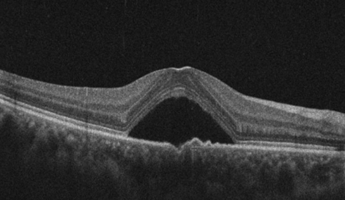 OCT scan of the macula in cross section, one of the imaging tests used at a retinal consultation.