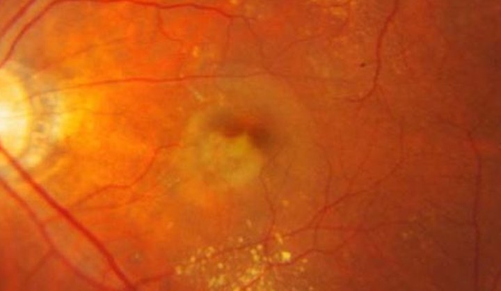 Colour fundus photograph of exudative polypoidal choroidal vasculopathy at the macula with surrounding hard exudate.
