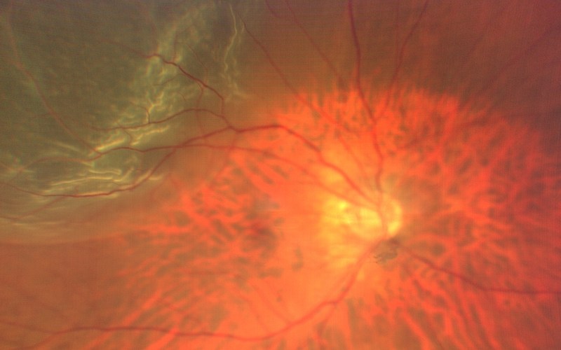 Fundus photograph of a retinal detachment, with pale folded retina lifted away from the wall of the eye.