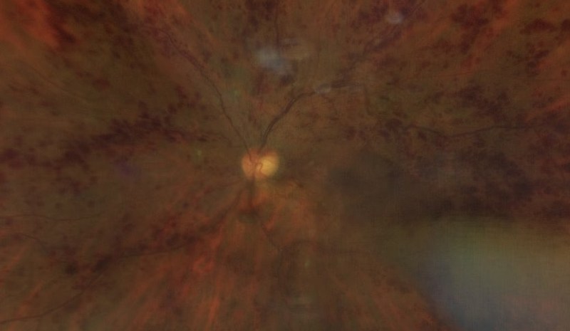 Fundus photograph of a central retinal vein occlusion with haemorrhages across the whole retina.