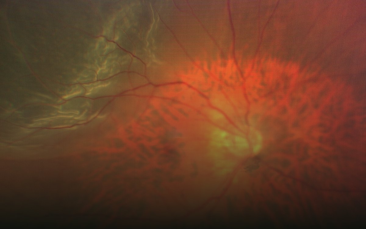 Widefield fundus photograph of a retinal detachment, with pale folded retina lifted away from the wall of the eye.