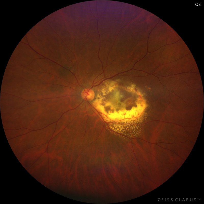 Widefield colour fundus photograph of neovascular age-related macular degeneration, showing a pale macular lesion ringed by yellow hard exudate temporal to the optic disc.