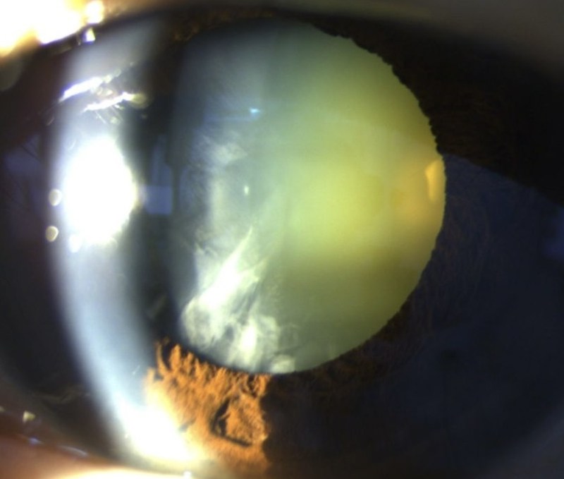 Slit lamp photograph of a dense cataract, showing the natural lens turned opaque yellow-white behind a dilated pupil.