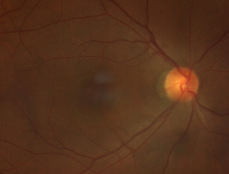 Colour fundus photograph zoomed on the macula in central serous chorioretinopathy, showing a subtle rounded area of dulled reflex where fluid has collected under the retina.