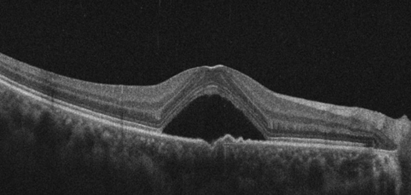 OCT cross section of central serous chorioretinopathy, showing a dome of dark subretinal fluid lifting the neurosensory retina away from the pigment epithelium at the fovea.