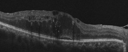 SD-OCT B-scan of diabetic macular oedema showing cystoid spaces in the inner and outer retina, punctate hyperreflective foci through the retinal thickness, and loss of laminar definition across the central retina.