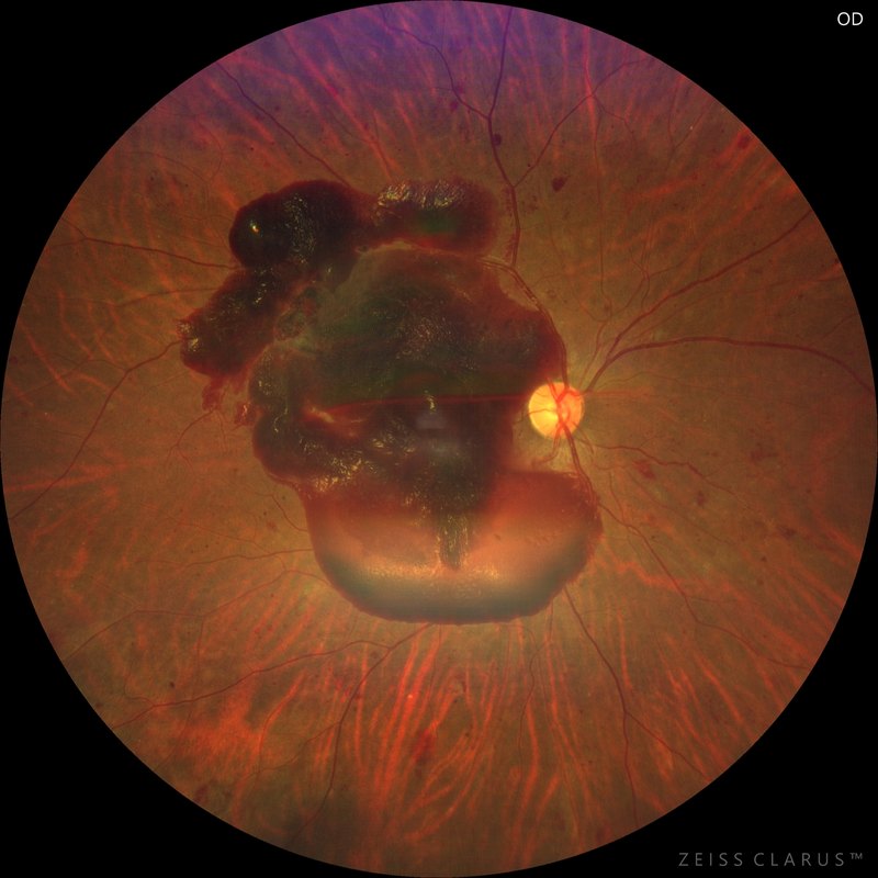 Widefield colour fundus photograph of proliferative diabetic retinopathy with a large premacular haemorrhage obscuring the macula.