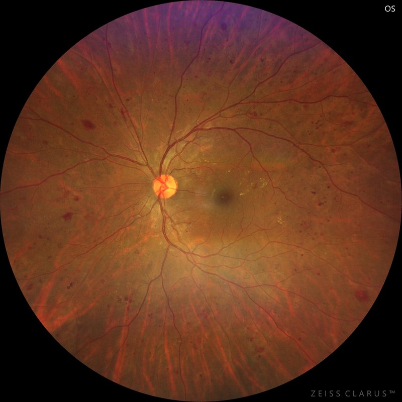 Widefield colour fundus photograph of proliferative diabetic retinopathy in which the new vessels at the optic disc are subtle and the macula is clear.