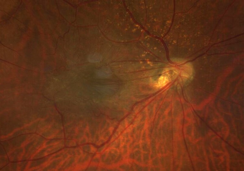 Zoomed colour fundus photograph of the macula showing an epiretinal membrane as a sheen of greyish tissue on the retinal surface with fine radiating retinal folds.