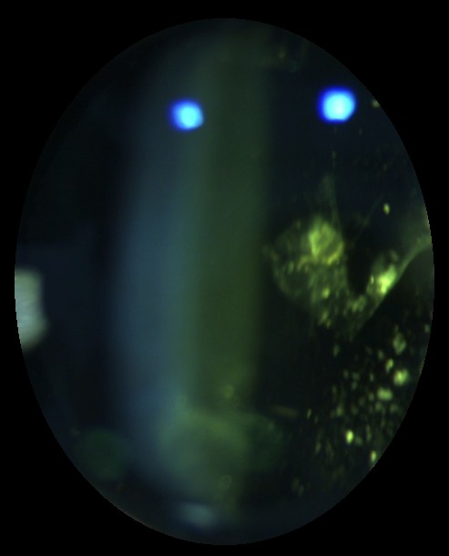 Slit lamp photograph looking through a dilated pupil into the vitreous, showing clumps of aggregated collagen and a shower of smaller particles that cause floaters.