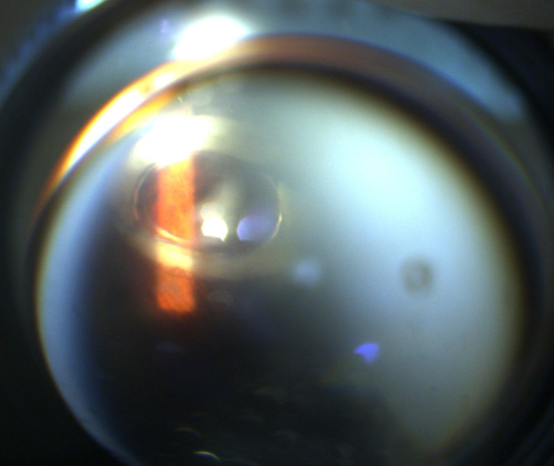 Photograph taken through an examination lens showing a fully dislocated intraocular lens resting on the inferior retinal surface.