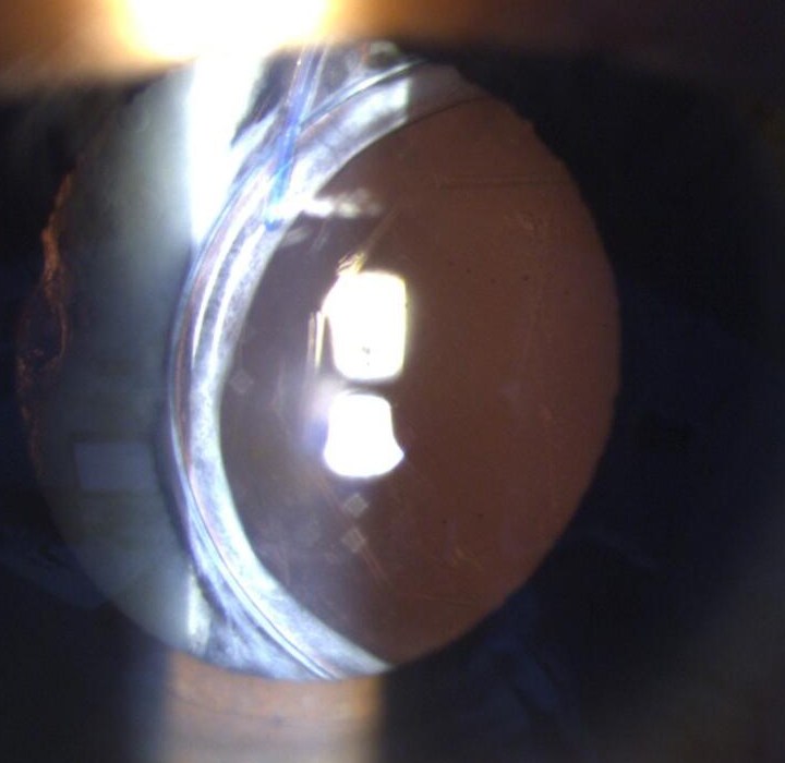 Slit lamp photograph of a subluxed intraocular lens, its edge visible crossing the pupil instead of sitting hidden behind the iris.