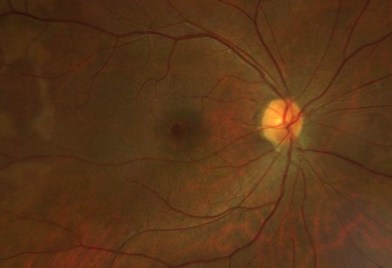 Colour fundus photograph of the macula showing a small, round, full-thickness macular hole at the fovea, with the optic disc at the right edge.