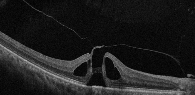 OCT cross section of a full-thickness macular hole, showing a defect through the whole retina with cystic fluid pockets in the raised hole edges and vitreous still attached at the edge.