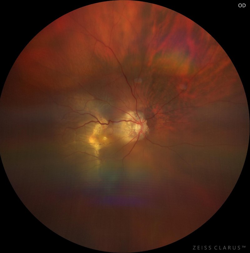 Colour fundus photograph of a macular hole retinal detachment in a highly myopic eye, with chorioretinal atrophy around the optic disc and macula.