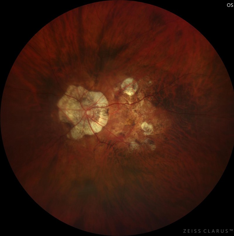Colour fundus photograph of a highly myopic eye showing peripapillary atrophy around the optic disc, diffuse and patchy macular atrophy, and a tessellated fundus.