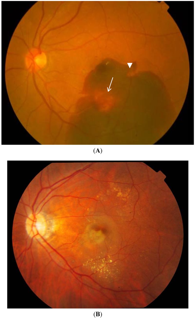 Colour fundus photographs of polypoidal choroidal vasculopathy: haemorrhagic type with a polyp and a notch in the pigment epithelial detachment, and exudative type with hard exudates.