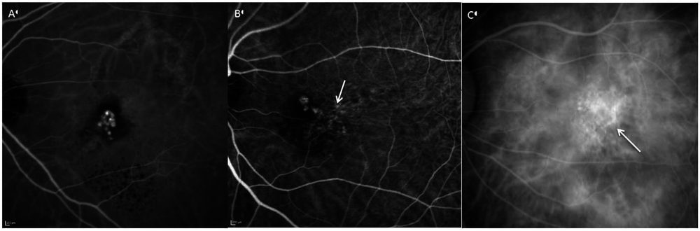 Indocyanine green angiography of polypoidal choroidal vasculopathy showing cluster-of-grapes, solitary, and string-of-pearls polyp patterns with branching vascular networks.