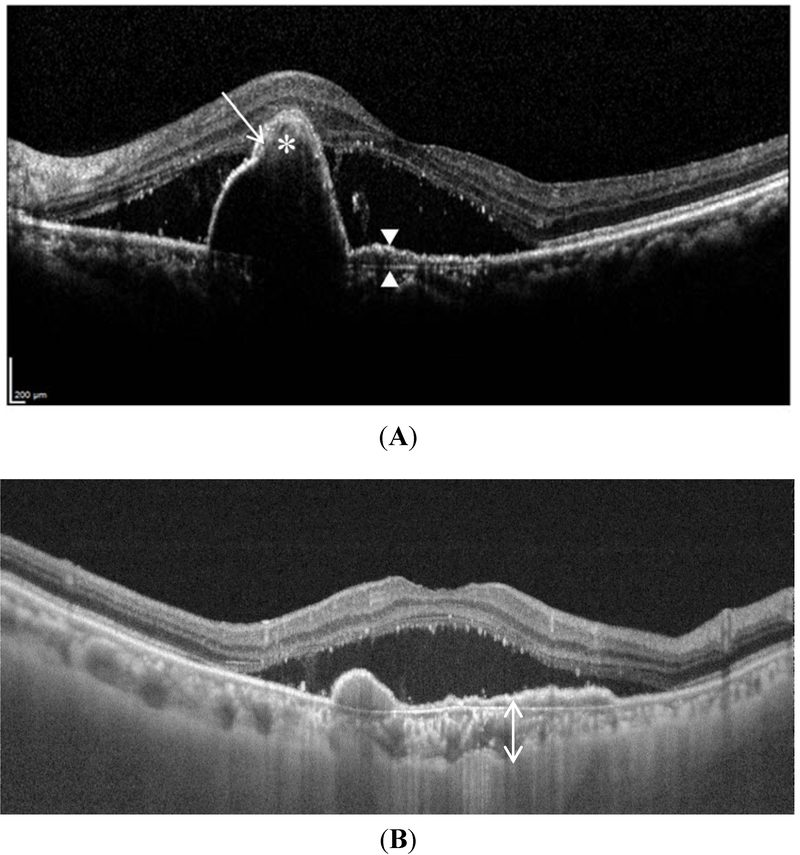 Optical coherence tomography of polypoidal choroidal vasculopathy showing a peaked elevation of the retinal pigment epithelium, the double-layer sign, and a thickened choroid on swept-source OCT.