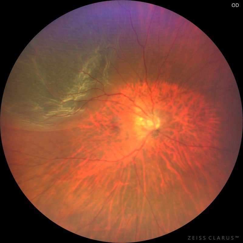 Widefield colour fundus photograph of a rhegmatogenous retinal detachment, showing pale folded detached retina in the upper part of the eye against the orange of retina still attached.