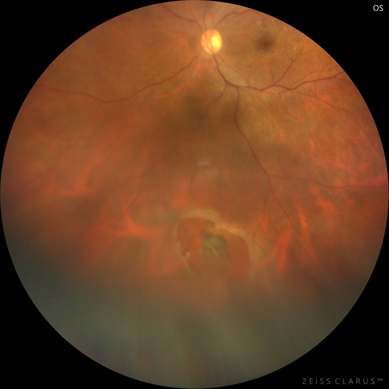 Widefield colour fundus photograph showing a retinal tear in the lower part of the retina.