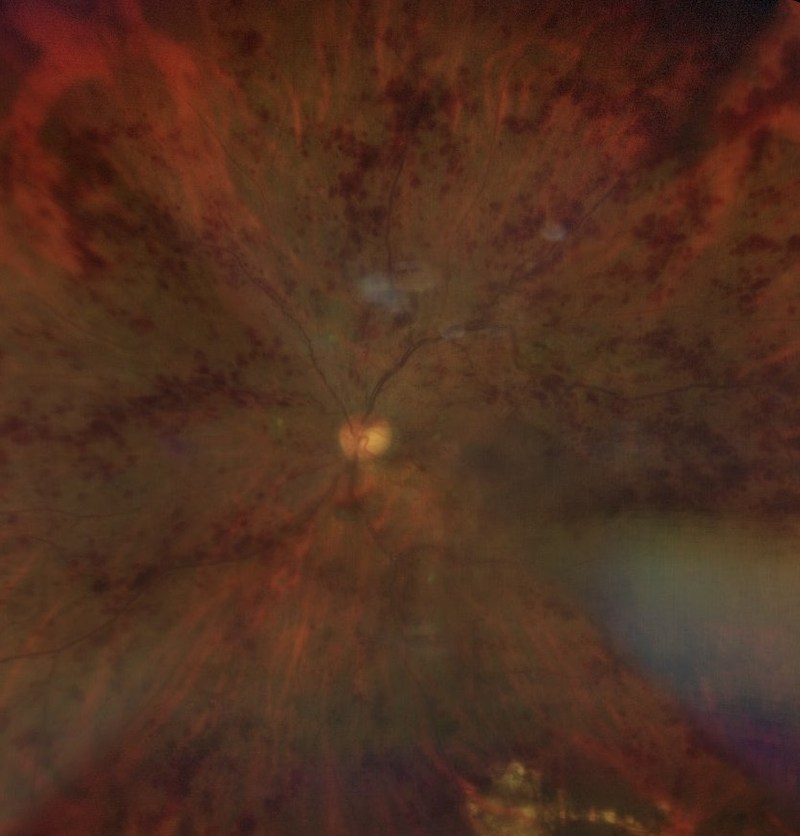Colour fundus photograph of a central retinal vein occlusion, showing haemorrhages spread across every quadrant of the retina radiating out from the optic disc, with pale cotton wool spots.